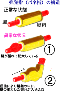 ばね指!