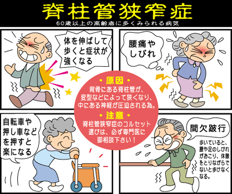 脊柱管狭窄症!