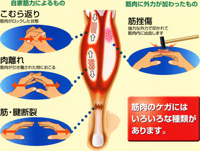肉離れ!