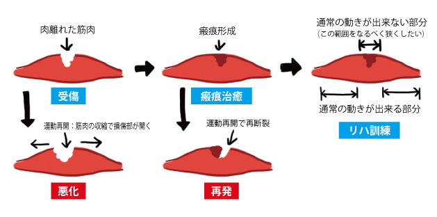 肉離れ!