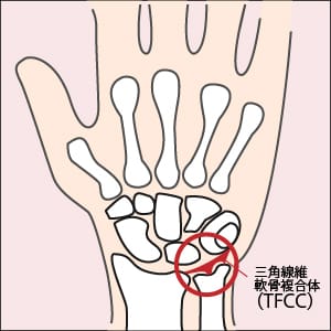 TFCC（三角繊維軟骨複合体）損傷！